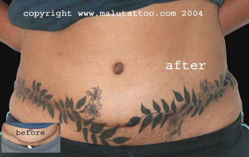 tattoo tummy tuck scar cover-up tattoo